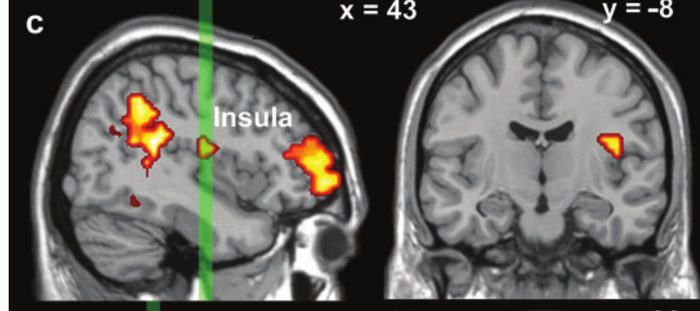 fMRI slices: right insula, shown in red/orange, activated more for experiential than narrative focus.