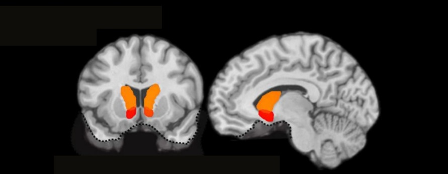 Coronal and sagittal fMRI slices showing the nucleus accumbens (red) and caudate nucleus (orange) regions of interest.