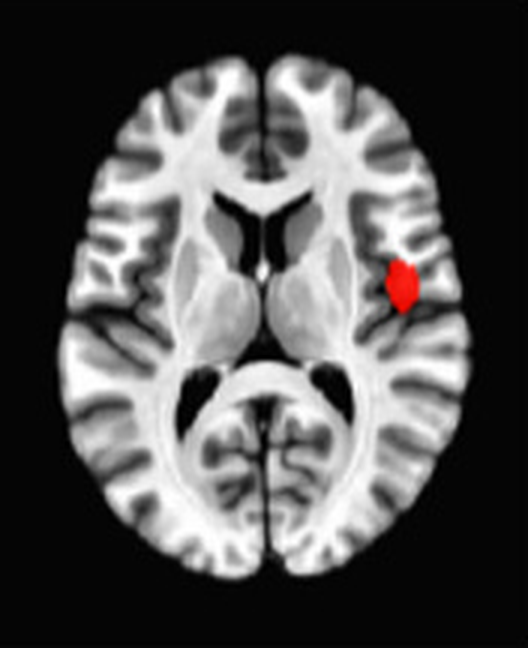 Axial fMRI slice 1 of 5: meta-analytic
                hyperactivation (warm) for aggregate meditation versus control tasks