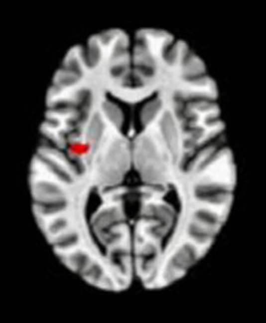 Axial fMRI slice 2 of 5: meta-analytic
                hyperactivation (warm) for aggregate meditation versus control tasks