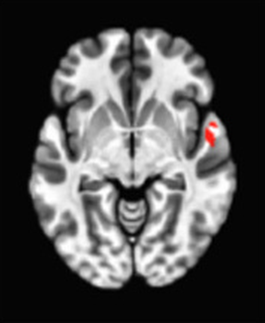 Axial fMRI slice 3 of 5: meta-analytic
                hyperactivation (warm) for aggregate meditation versus control tasks