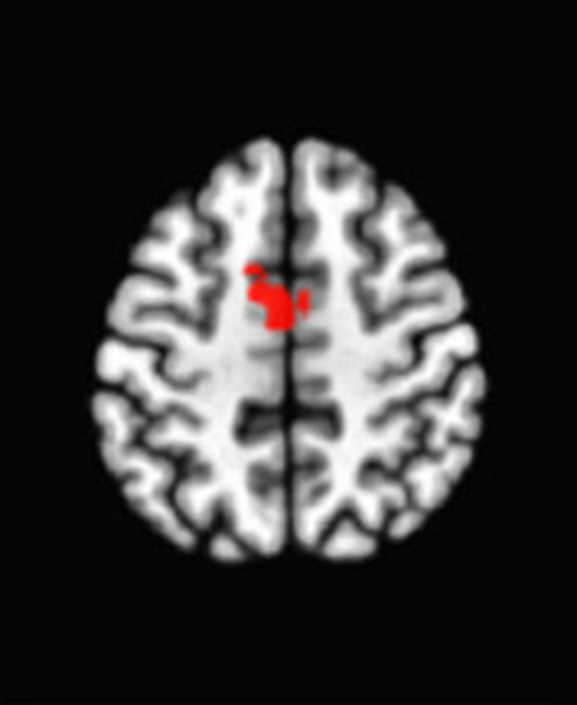 Axial fMRI slice 4 of 5: meta-analytic
                hyperactivation (warm) for aggregate meditation versus control tasks
