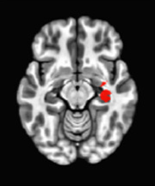 Axial fMRI slice 5 of 5: meta-analytic
                hyperactivation (warm) for aggregate meditation versus control tasks