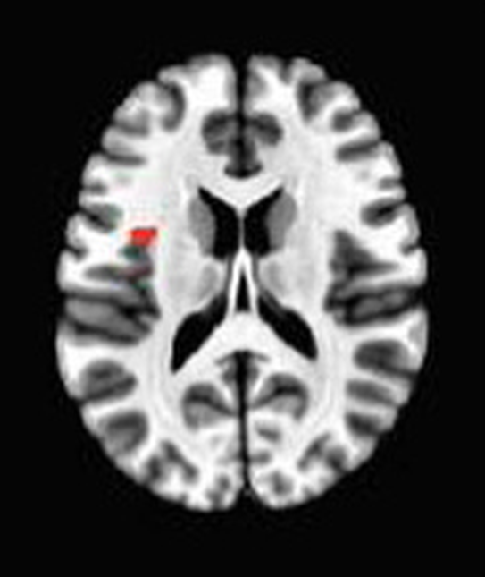 Axial fMRI slice 1 of 5: meta-analytic
                hyperactivation (warm) and hypoactivation (cool) for focused attention versus
                control tasks