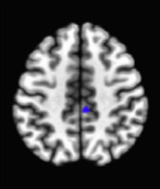 Axial fMRI slice 2 of 5: meta-analytic
                hyperactivation (warm) and hypoactivation (cool) for focused attention versus
                control tasks