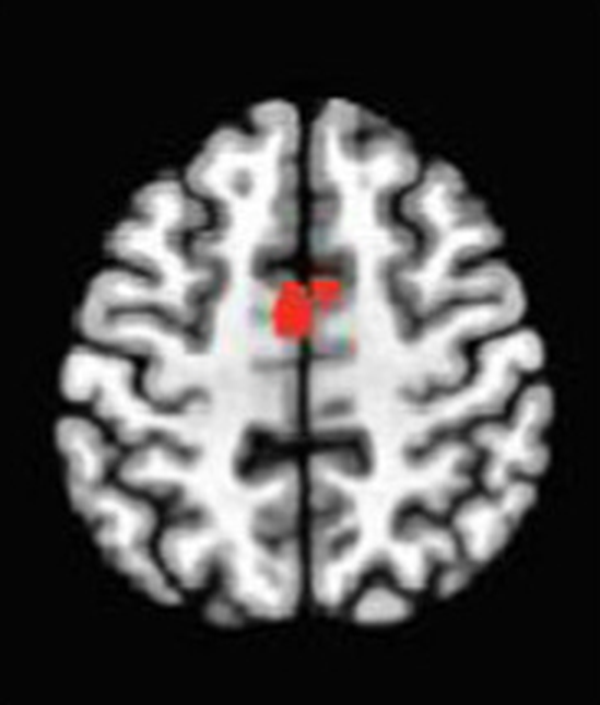 Axial fMRI slice 3 of 5: meta-analytic
                hyperactivation (warm) and hypoactivation (cool) for focused attention versus
                control tasks