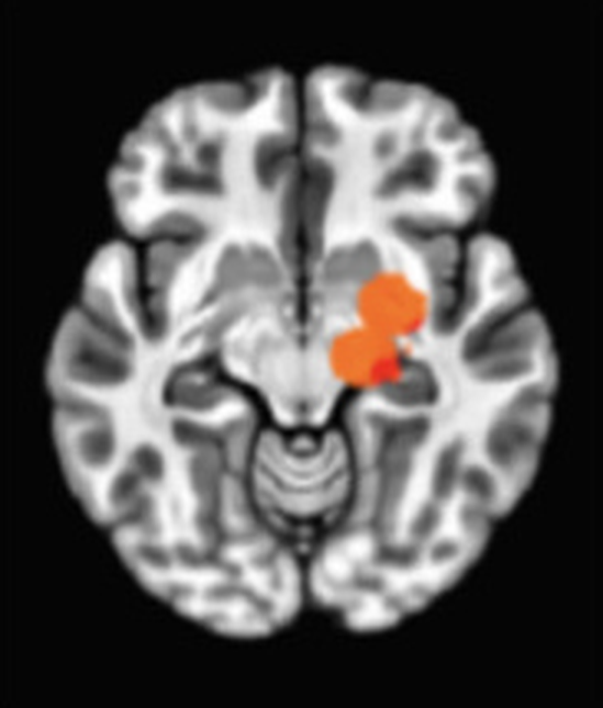 Axial fMRI slice 4 of 5: meta-analytic
                hyperactivation (warm) and hypoactivation (cool) for focused attention versus
                control tasks
