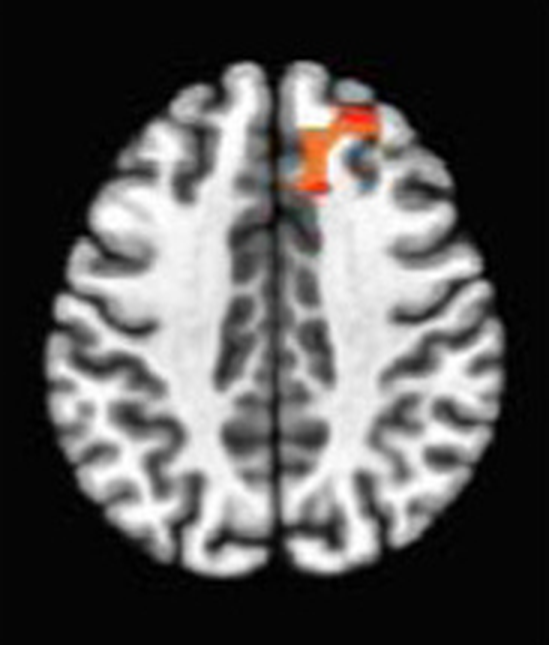 Axial fMRI slice 5 of 5: meta-analytic
                hyperactivation (warm) and hypoactivation (cool) for focused attention versus
                control tasks