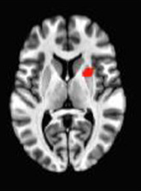 Axial fMRI slice: meta-analytic
                hyperactivation (warm) for mantra recitation versus control tasks