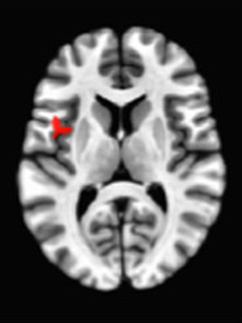 Axial fMRI slice 1 of 5: meta-analytic
                hyperactivation (warm) and hypoactivation (cool) for open monitoring versus control
                tasks