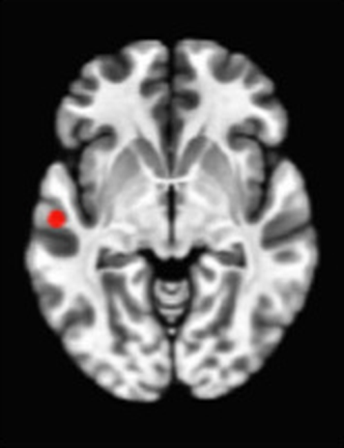 Axial fMRI slice 2 of 5: meta-analytic
                hyperactivation (warm) and hypoactivation (cool) for open monitoring versus control
                tasks