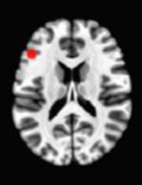 Axial fMRI slice 3 of 5: meta-analytic
                hyperactivation (warm) and hypoactivation (cool) for open monitoring versus control
                tasks
