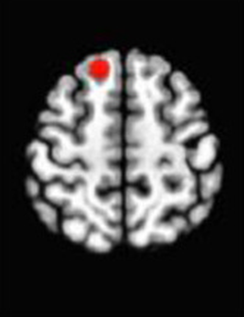 Axial fMRI slice 4 of 5: meta-analytic
                hyperactivation (warm) and hypoactivation (cool) for open monitoring versus control
                tasks