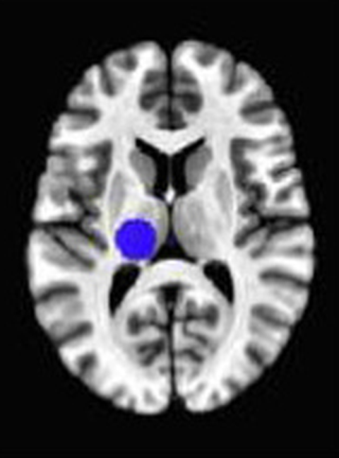 Axial fMRI slice 5 of 5: meta-analytic
                hyperactivation (warm) and hypoactivation (cool) for open monitoring versus control
                tasks